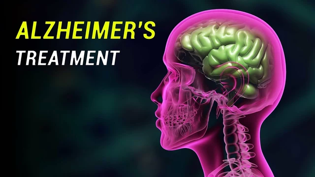 Perguntas Frequentes Sobre Donepezil para Tratamento do Alzheimer